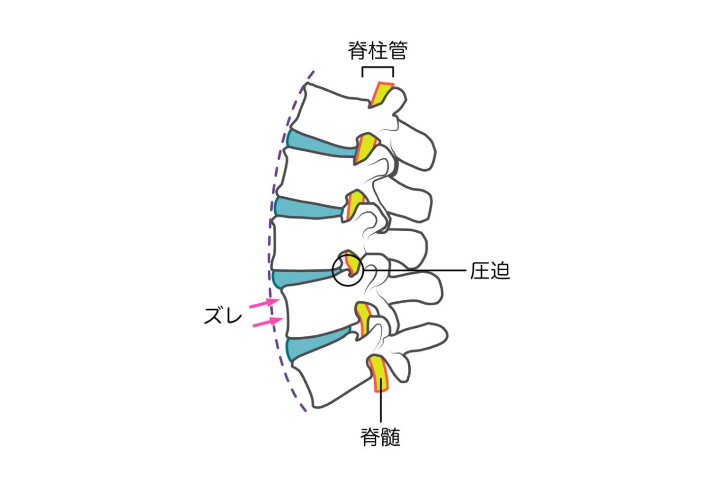病院での脊柱管狭窄症治療